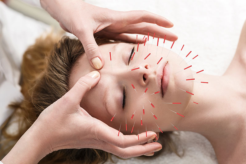 Acupuncture: What does it treat? | Ana Heart